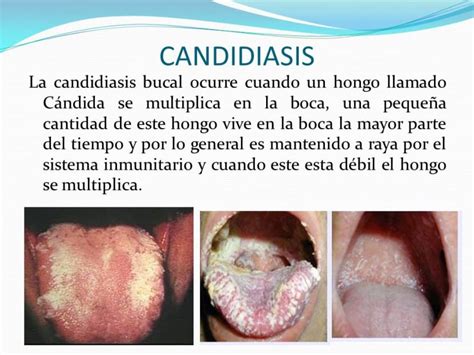 síntomas de candidiasis oral